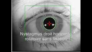 Nystagmus horizontal et rotatoire sans et après fixation [upl. by Dwan]