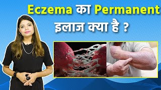 एक्जिमा का घरेलु इलाज क्या है  Eczema Ka Permanent Treatment Kya Hai  Boldsky [upl. by Lorin]