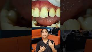 Teeth gap filling பன்னா செயற்கையாக தெரியுமாshorts [upl. by Blas264]