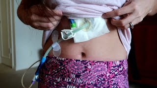 How My Feeding Tube Works  Two Months Post Op 73117 [upl. by Eira]