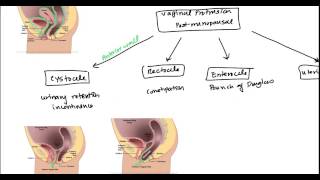 Uterine Prolapse and Vaginal Prolapse for USMLE [upl. by Tye]