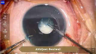 Congenital cataract poorly dilating pupil  Lens aspiration PCCC AV PCIOL [upl. by Ivz]