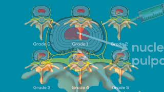 The Relevance of XRays and MRI in Diagnosing Internal Disc Disruption 3 Minutes [upl. by Letch]