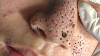 Big Cystic Acne Blackheads Extraction Blackheads amp Milia Whiteheads Removal Pimple Popping  5431 [upl. by Gib196]