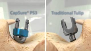 Spine Wave CapSure® PS3 Spine System [upl. by Suoiluj]