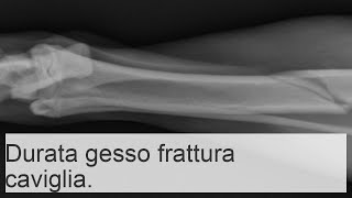 Frattura della caviglia con e senza spostamento quanto tempo bisogna camminare con il gesso [upl. by Slavin]