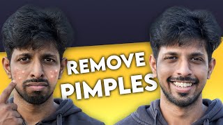 Get Rid of Pimples Forever In 2 STEPS 100 Guaranteed Results [upl. by Lauzon145]