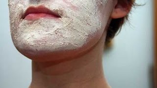 Face Eczema  Atopic Dermatitis  Eczema Dermatitis Rash Treatment [upl. by Sharona]