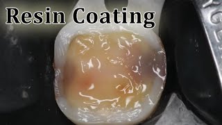 Biomimetic  Resin Coating  فوائد طبقة الفلوبل كومبوزت [upl. by Thorny]