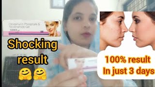 Clinsol gel review in Hindi  Clinsol gel  Pimple free skin naazkhanofficial [upl. by Asecnarf]