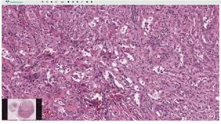 Adenomatoid Tumor  Histopathology [upl. by Adolphe]