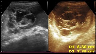 Chronic Liver Disease  Ovarian cyst Peritoneal inclusion cyst [upl. by Seamus388]