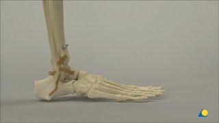 Ankle Arthrodesis Using an Anterior Approach [upl. by Inat]