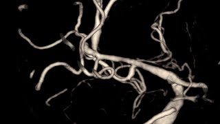 Aneurysm MCA Rebleeding [upl. by Cocks]