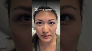 Eyelid surgery recovery photos day by day beforeandafter female [upl. by Gideon103]