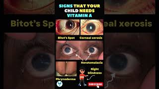 Catch them Early 🤲 👁Signs Your Child Might Have a Vitamin A Deficiency  vitamin shorts baby [upl. by Ayhtnic]