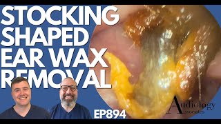 STOCKING SHAPED EAR WAX REMOVAL  EP894 [upl. by Hanni]