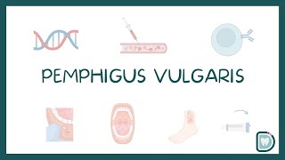 Pemphigus Vulgaris Oral Cavity Symptoms and Treatment [upl. by Hekker]