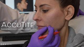 AccuTite Skin Tightening amp Facial Contouring with Dr Kian Karimi [upl. by Malvia659]