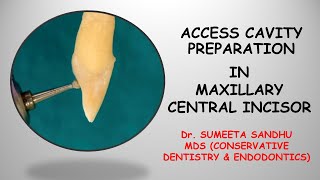 Incisor access opening Incisor access cavity RCT Easy endodontics for maxillary incisor [upl. by Neyu745]