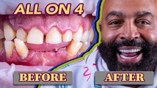 All on 4 Dental Implants Before amp After Smile Transformations  My New Smile Dental [upl. by Anaitsirc325]