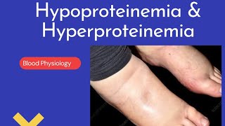 Hypoproteinemia amp Hyperproteinemia Causes effect and synthesis of Plasma protein [upl. by Nomi801]