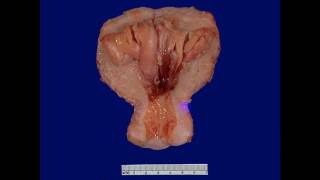 Pathology  dr Nafeaa  Neoplasia كل ما تريد عن الأورام [upl. by Areek]