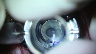 Manual Intacs Implantation for Keratoconus [upl. by Richmal]