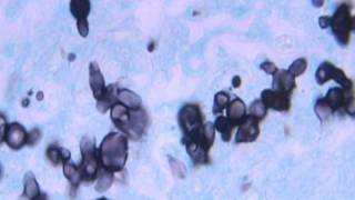 Blastomycosis Blastomyces dermatitidis [upl. by Adest]