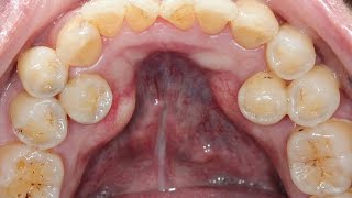 What is Supernumerary Teeth Definition Causes amp Treatment [upl. by Aneleiram]