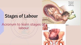 Stages of Labour acronym to learn stages of Labour easy to learn [upl. by Rehsa]