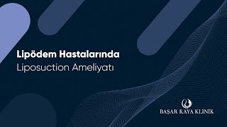 Lipödem Hastalarında Liposuction Ameliyatı [upl. by Ehtyde]