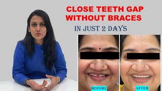 CLOSE TEETH GAP WITHOUT BRACES in Hindi  IN JUST 2 DAYS [upl. by Nomsed]