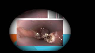 Endoscopic treatment of zenker diverticulum  Russells Hall Hospital [upl. by Jaime]