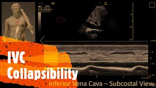 Estimate the Right Atrial Pressure using the IVC Perioperative amp Critical Care ECHO POCUS [upl. by Arraes518]