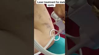 Laser treatment for dark spots [upl. by Ecidnak830]