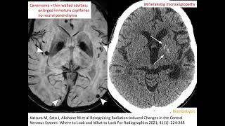 67 Radiation induced cavernoma and mineralising microangiopathy popcorn capillary teleangiectasia [upl. by Andi284]