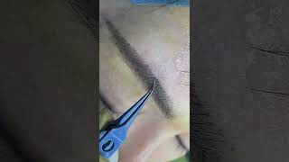 eyebrow transplantation eyebrow eyebrows sopracciglio sobrancrlhas cejas sourcils eyelashes [upl. by Einehpets]