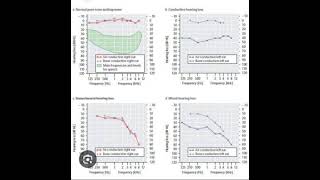 Audiometric fundamentals [upl. by Phedra]