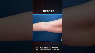 Brachioplasty Armlift Plastic surgery Kandy Sri Lanka Dr Ananda Jayawardena cosmeticsurgery [upl. by Ruyam]