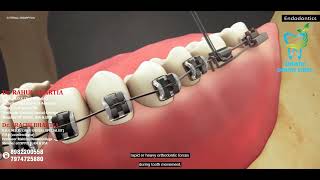 External Root Resorption Endodontics  Causes and Treatments by Bhartia Dental Clinic [upl. by Viking]