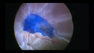 Vitrectomy for Retinal Detachment with PVR  Retinal Detachment  Dr Manish Nagpal [upl. by Vowel760]