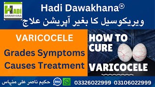 Varicocele Symptoms Causes Treatment Without Surgery  Varicocele ka ilaj in urdu  Hindi kya hai [upl. by Leary79]