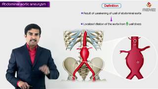 Abdominal aortic aneurysm  Usmle step 1  Causes  Signs amp symptoms  diagnosis  treatment [upl. by Krystle]