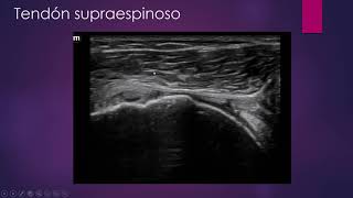 ROTURA CRONICA DEL TENDON SUPRAESPINOSO DE ANCHURA TOTAL [upl. by Natalee]