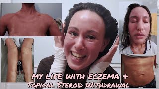 Intro to my life with eczema atopic dermatitis amp topical steroid withdrawal [upl. by Nelac]