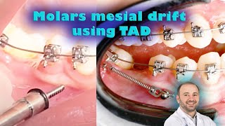 Dental implant or spaces closure by braces using tads miniimplant for molar mesial drifting [upl. by Rochelle]