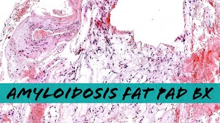 Systemic Amyloidosis on abdominal fat pad biopsy with Congo red stain pathology dermatopathology [upl. by Aneres346]