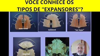 VOCÊ CONHECE OS TIPOS DE APARELHOS EXPANSORES [upl. by Saitam]