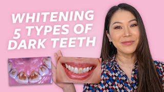 5 Types of Teeth Stains and How to Remove Them  At Home amp In Office Teeth Whitening [upl. by Fulviah]